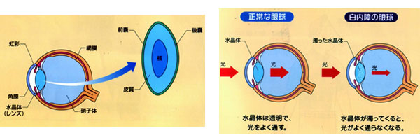 白内障画像