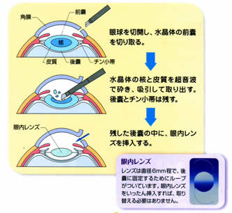 白内障画像