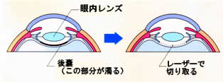 白内障画像