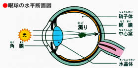 飛蚊症