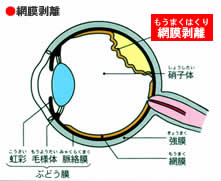 飛蚊症