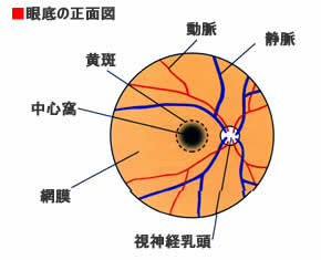 加齢黄斑変性