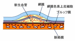 加齢黄斑変性