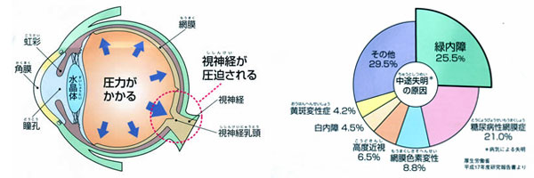 緑内障画像